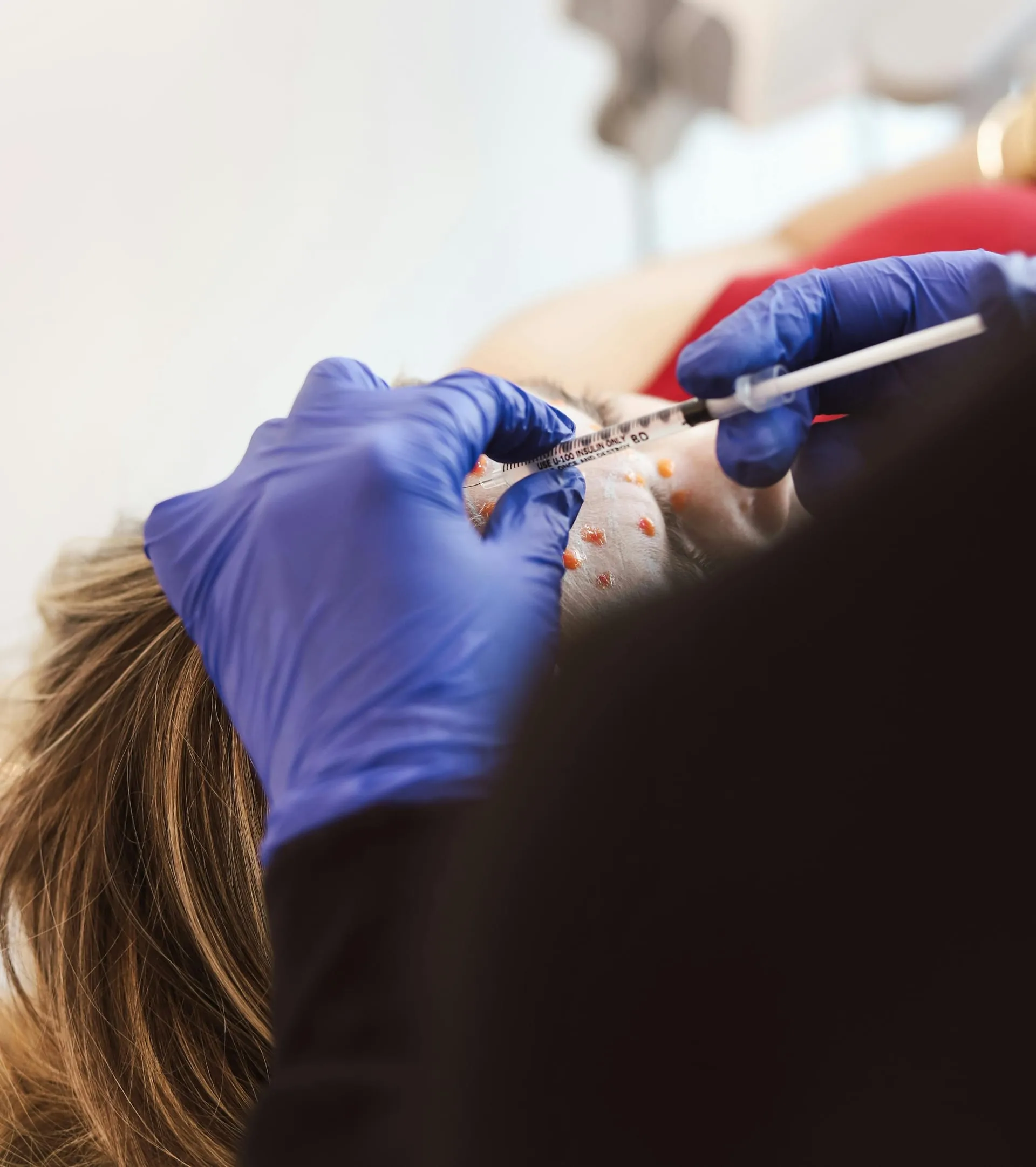 Botox treatment being administered to a patient