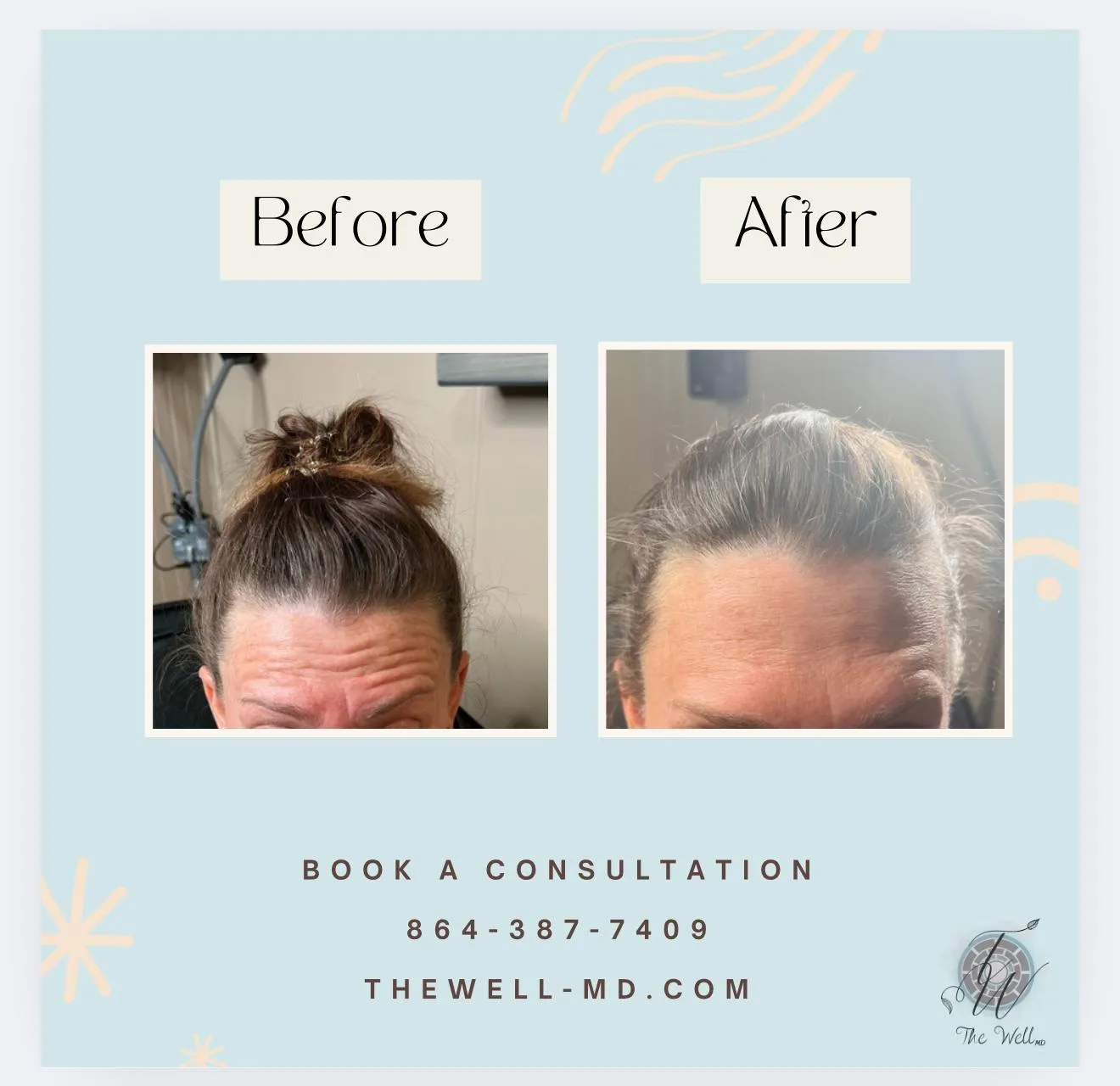 Botox before and after comparison