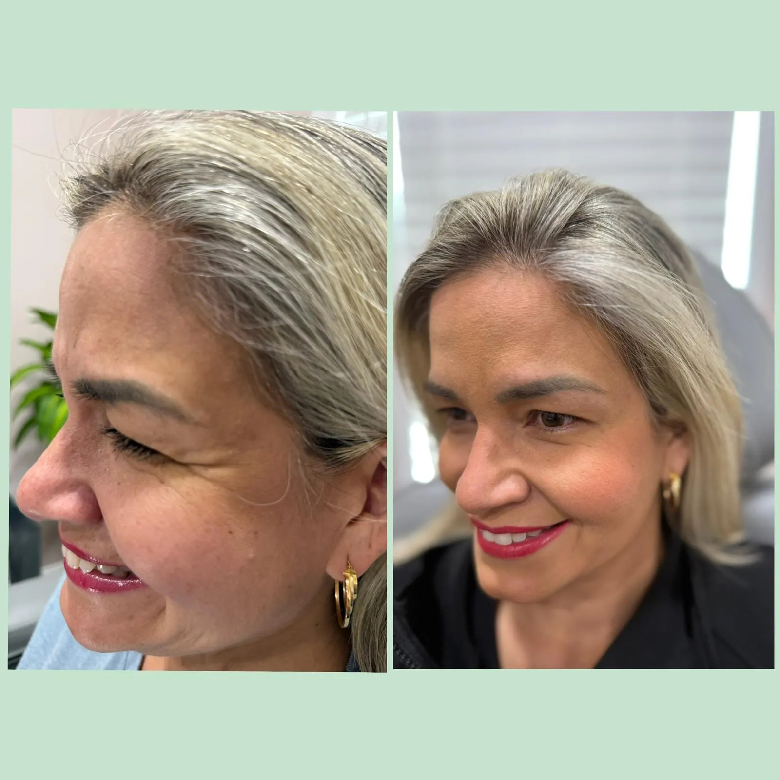 Botox treatment results