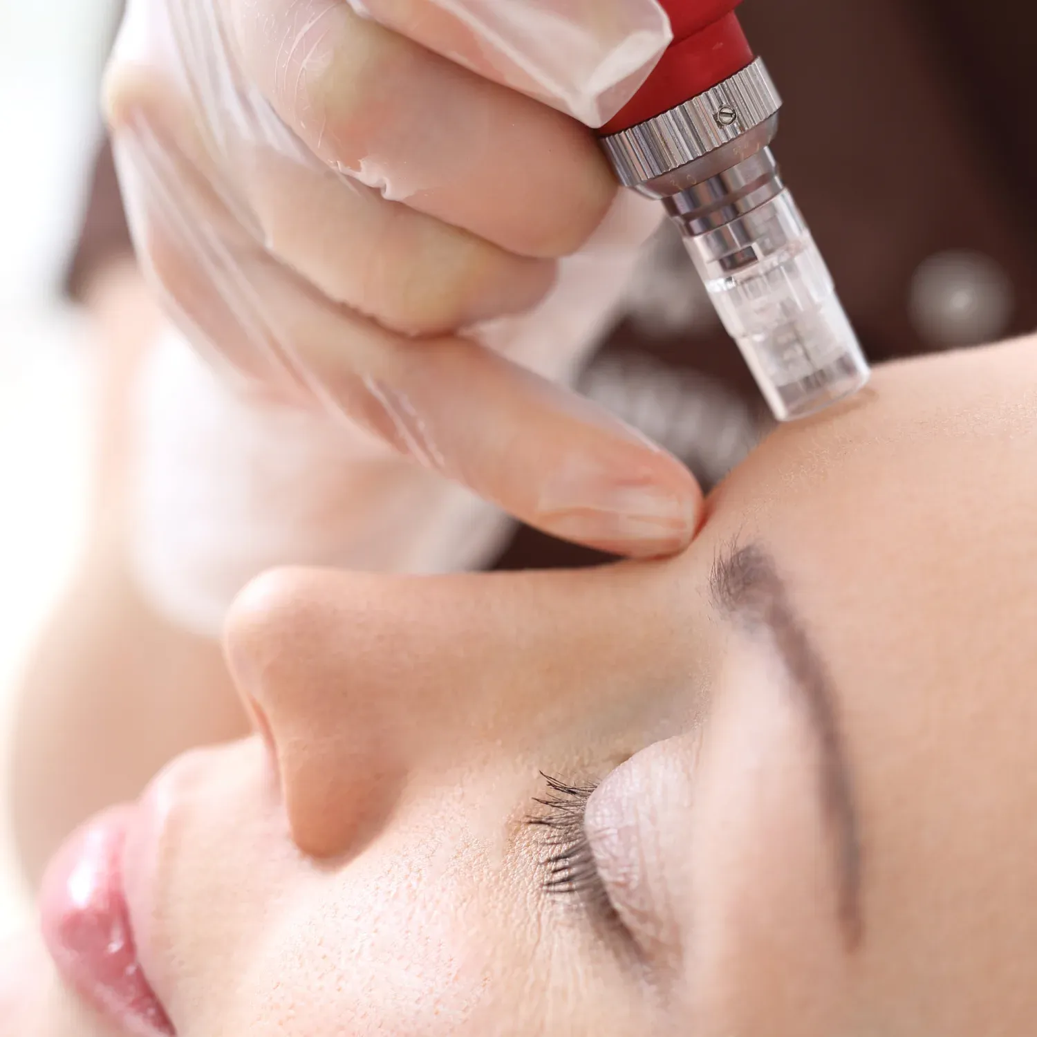 Microneedling treatment in progress